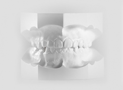 Réalisation de modèles d'étude orthodontique